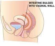 small bowel prolapse Enterocele | TX Small Bowel Prolapse Enterocele | TX