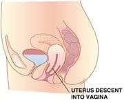Uterine Prolapse Texas Uterine Prolapse Texas