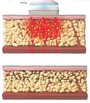 tissue fat layer 3 1