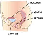 vaginal vault prolapse