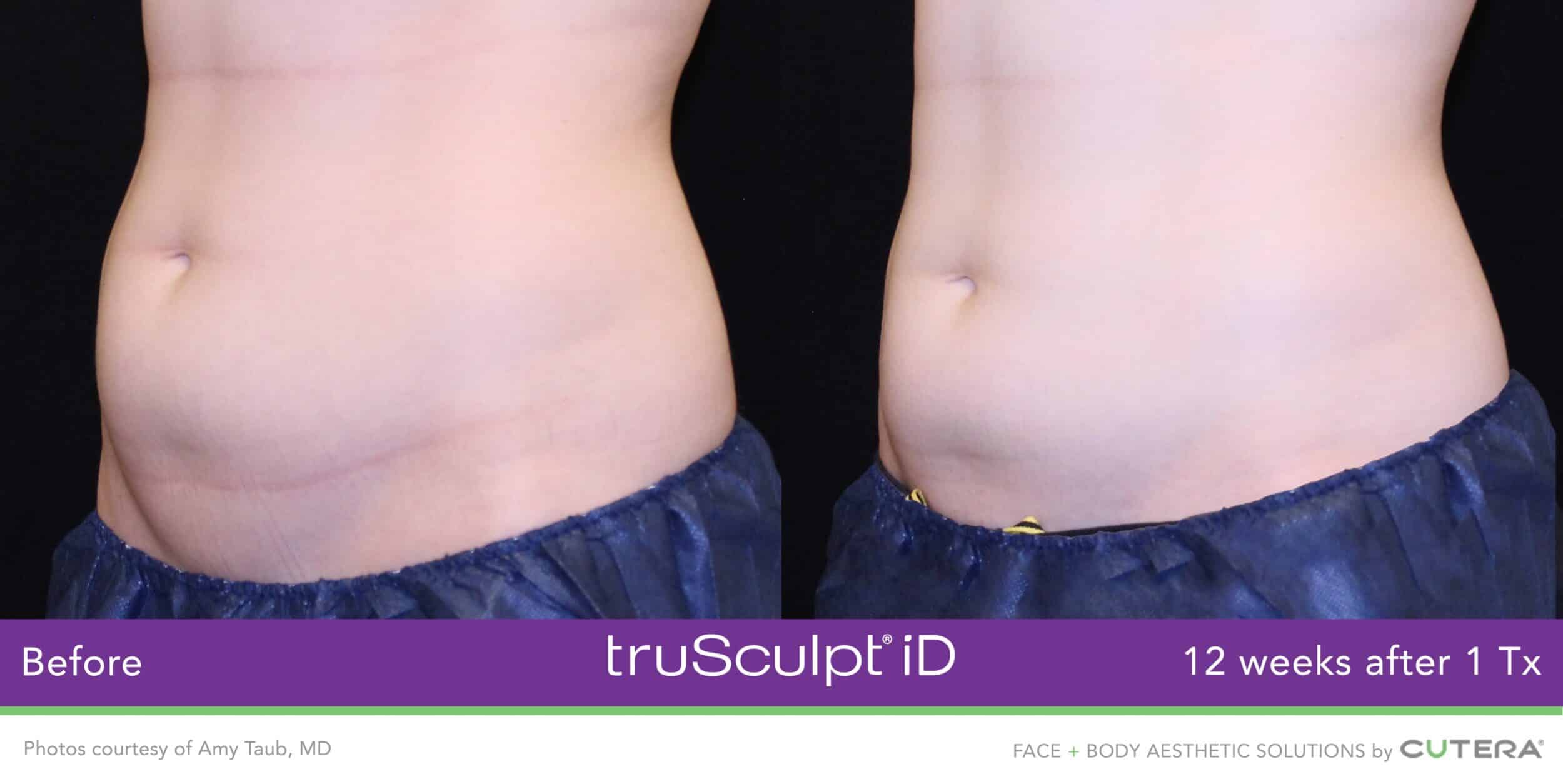 trusculpt id amy taub md 3