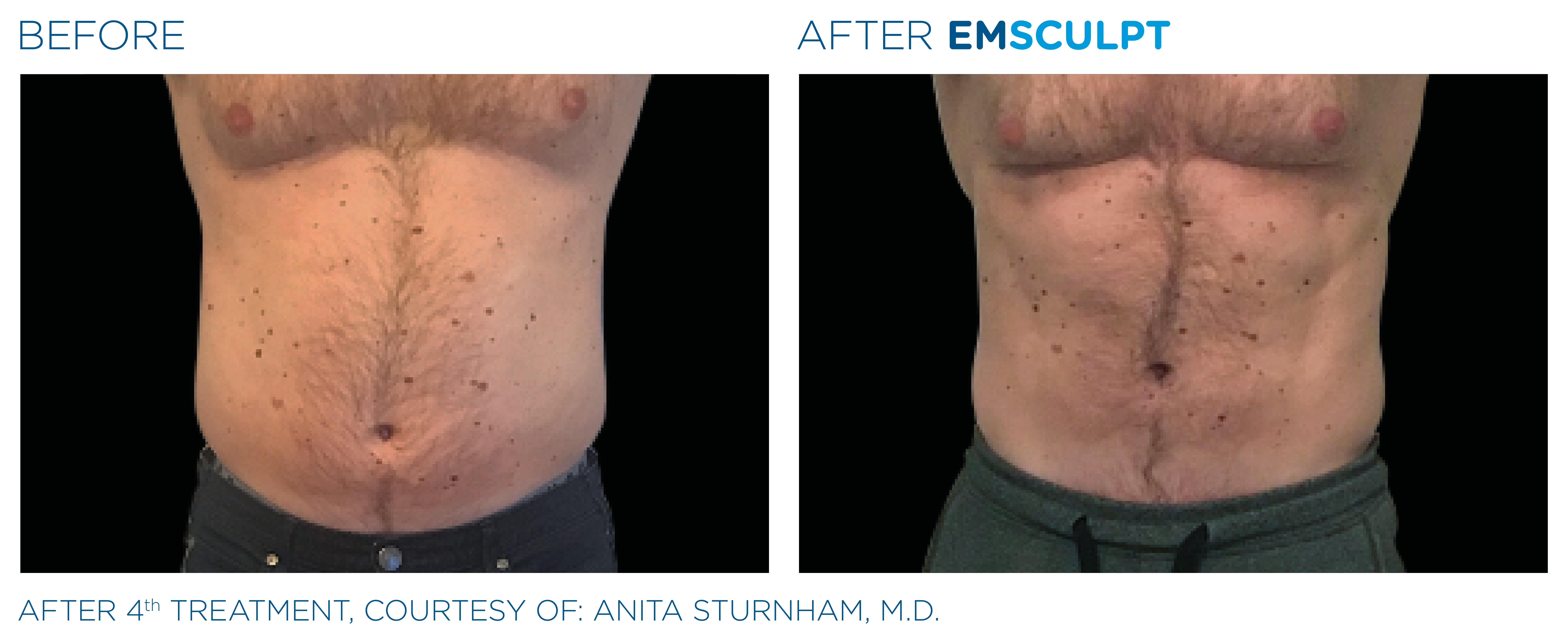 Emsculpt, Best Non-Invasive Body Toning Procedure