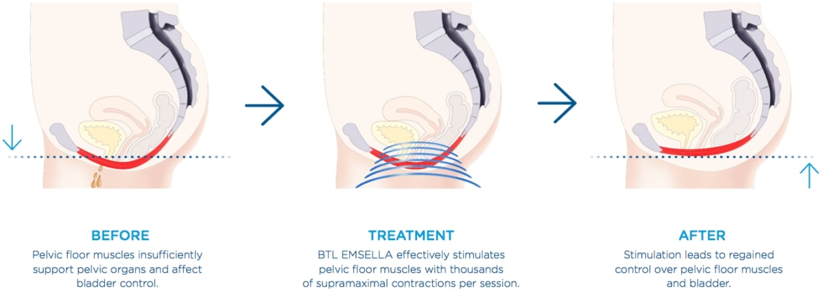 female incontinence treatment